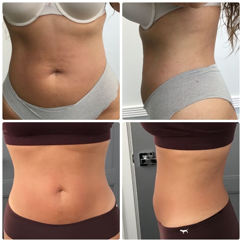 Painless Body Contouring - Fort Lauderdale FL